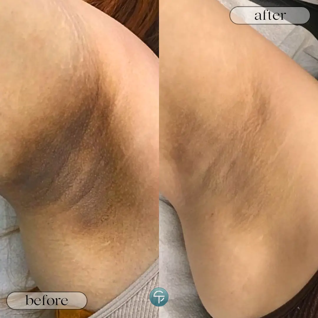 Laser Intimate Skin Lightening