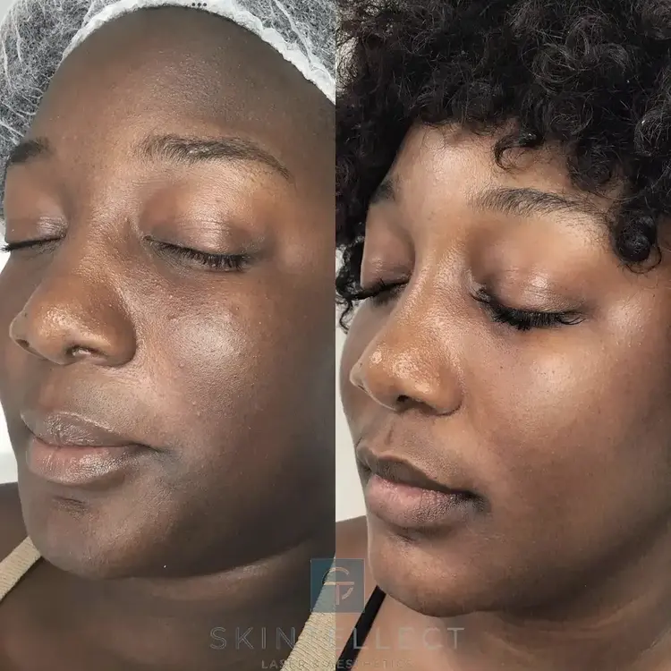 Laser Pigment Removal | 1 Session