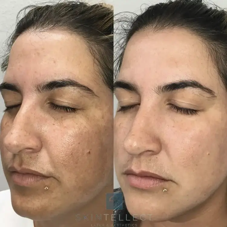 Laser Pigment Removal | 4 Sessions