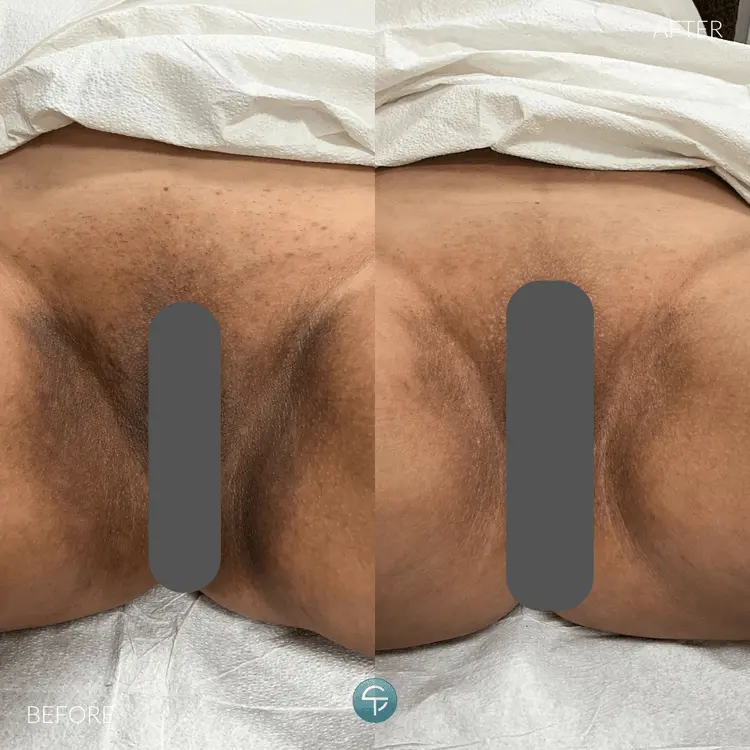 Laser Intimate Lightening | 2 Sessions