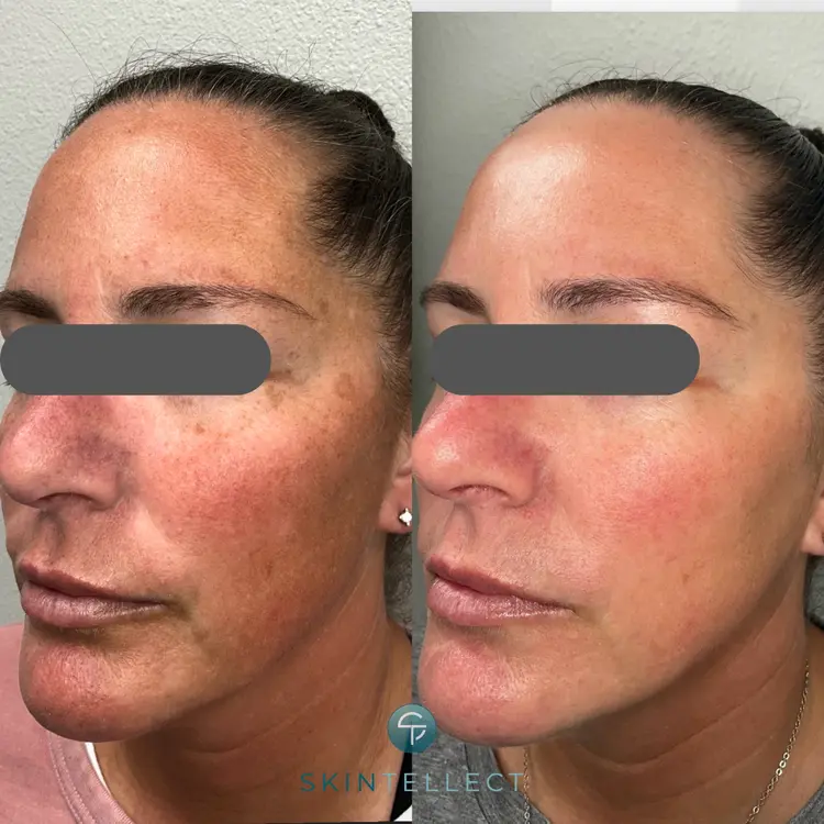 Laser Pigment Removal | 2 Sessions