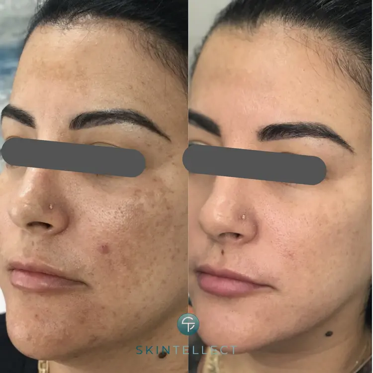 Laser Pigment Removal | 4 Sessions