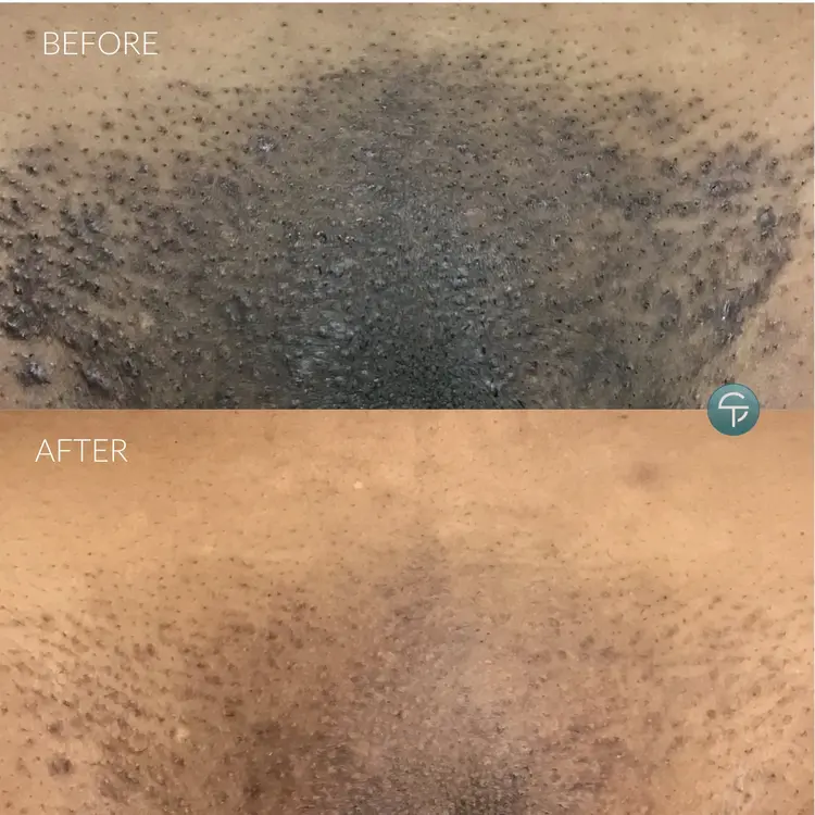 Laser Intimate Lightening | 3 Sessions