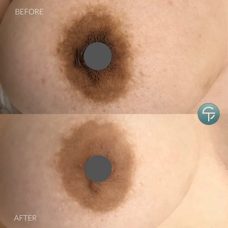 Laser Intimate Lightening | 3 Sessions