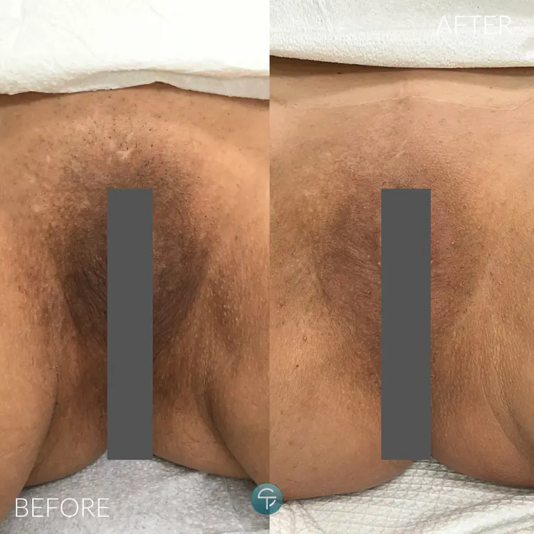 Laser Intimate Lightening | 3 Sessions