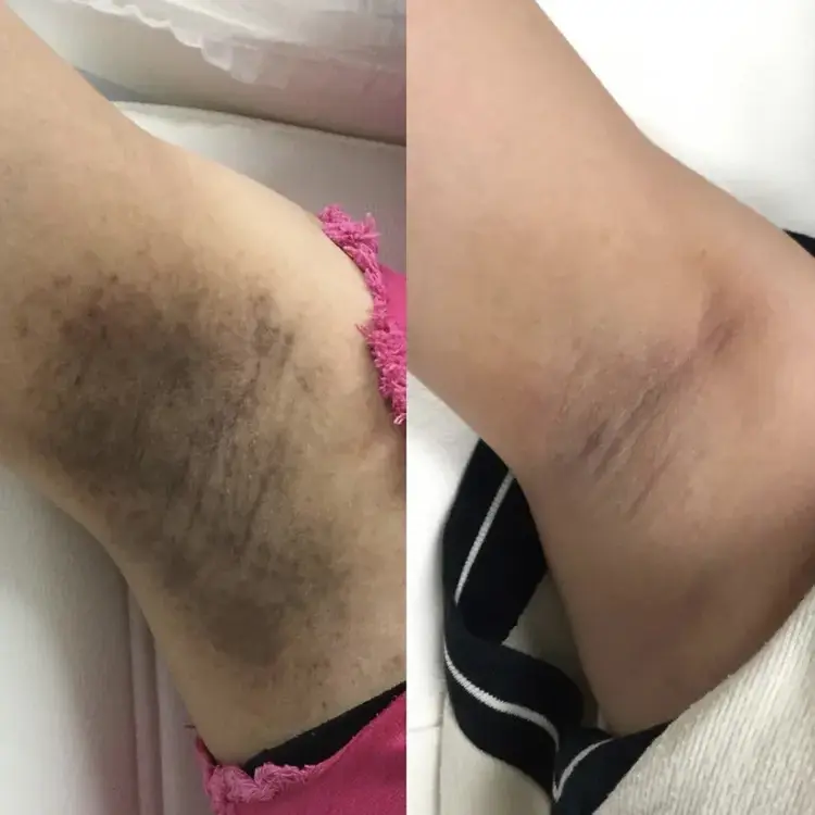 Laser Intimate Skin Lightening