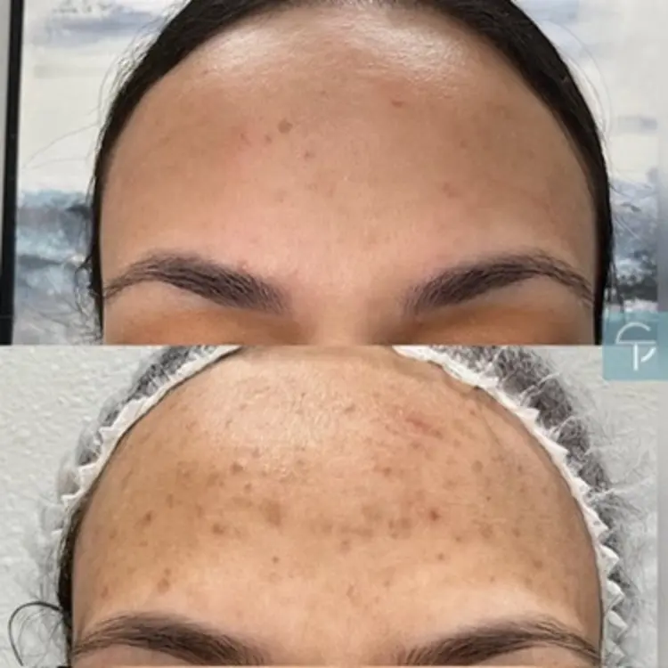 Laser Pigment Removal | 2 Sessions