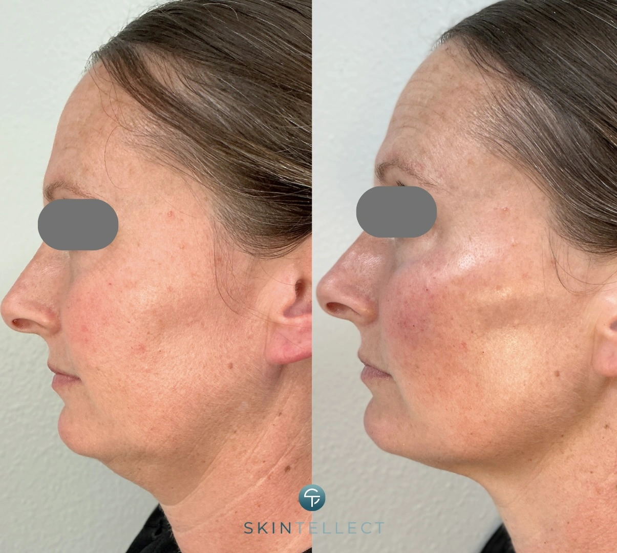 Cheek Filler