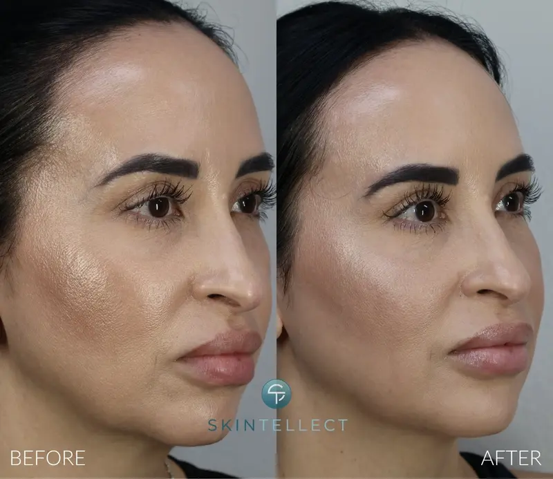 Botox & Filler for Balancing