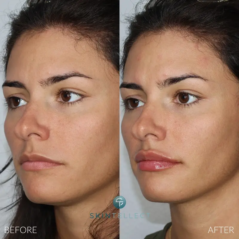 Lip Filler | 1 Syringe