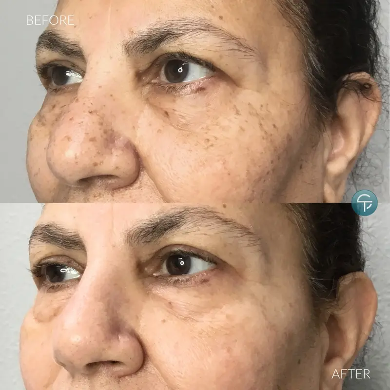 Laser Pigment Removal | 1 Session