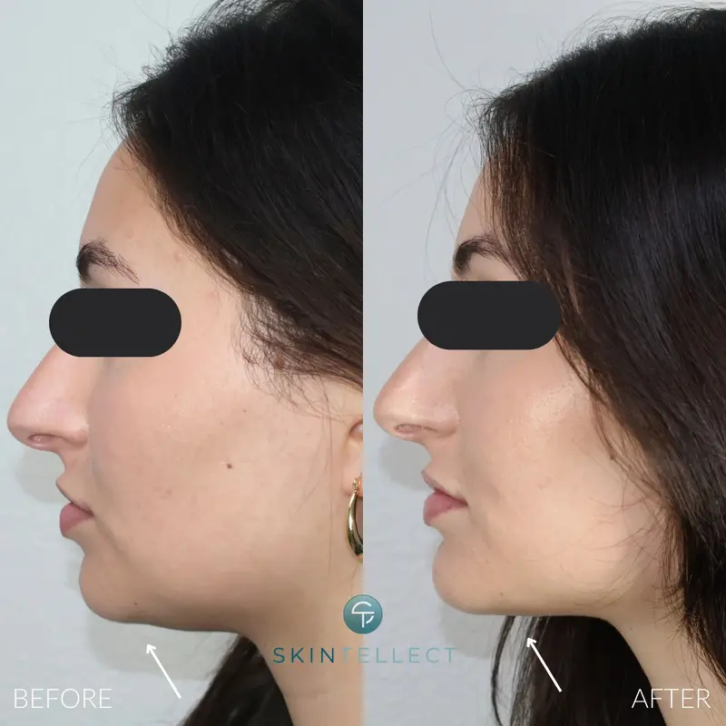Chin Filler