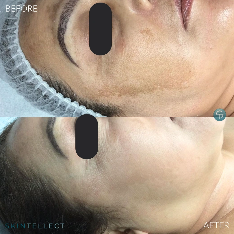 Laser Pigment Removal | 4 Sessions