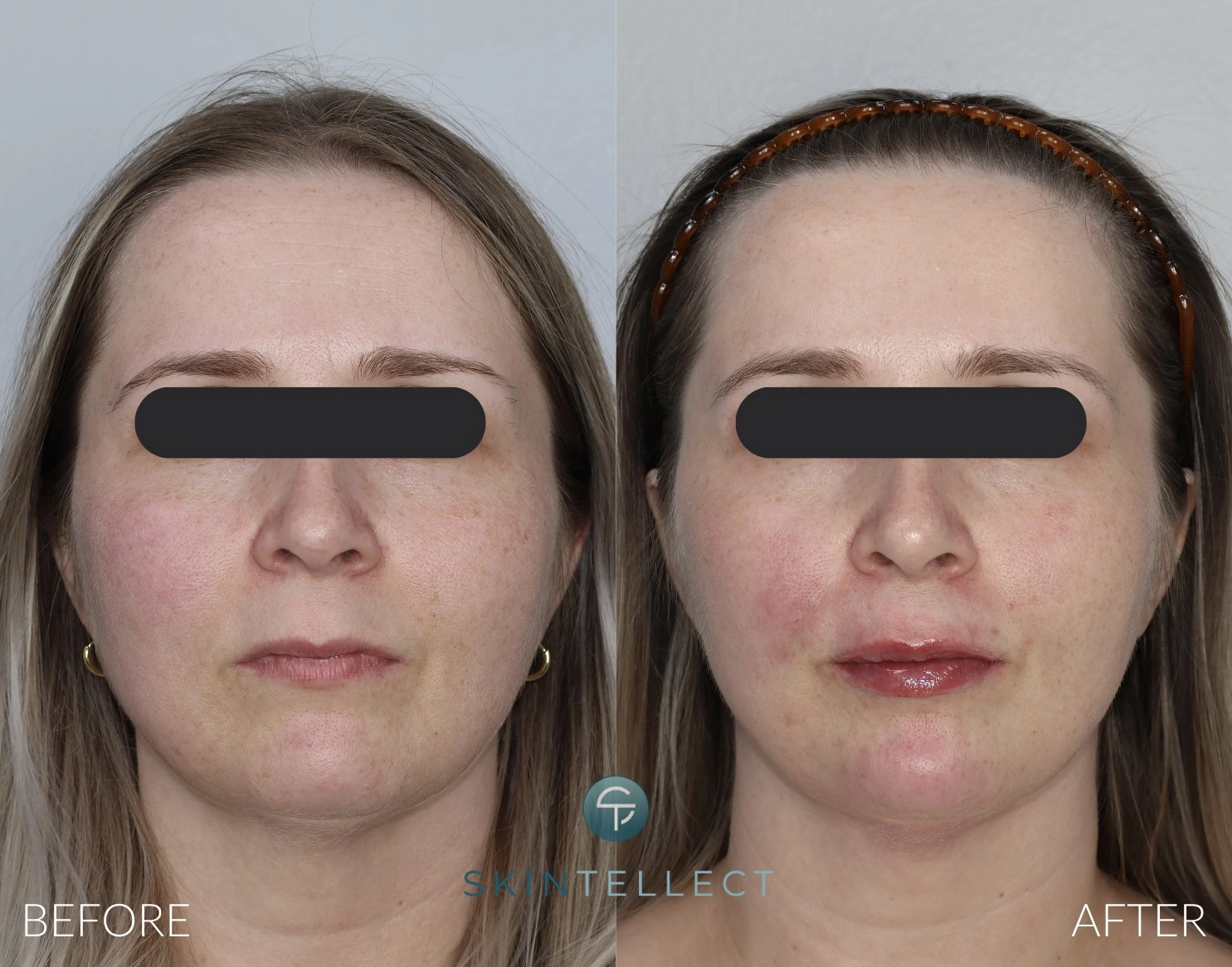 Lip & Chin Filler