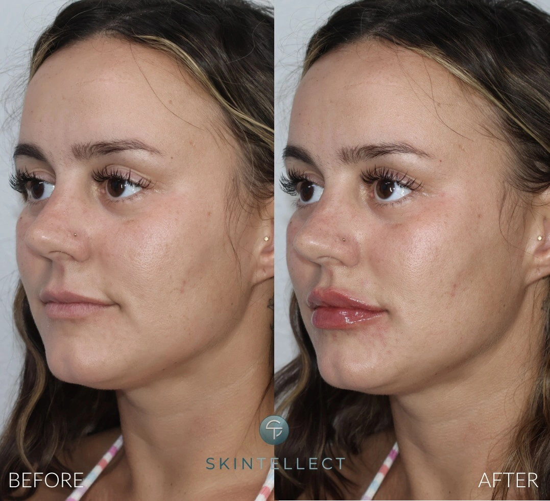 Lip Filler