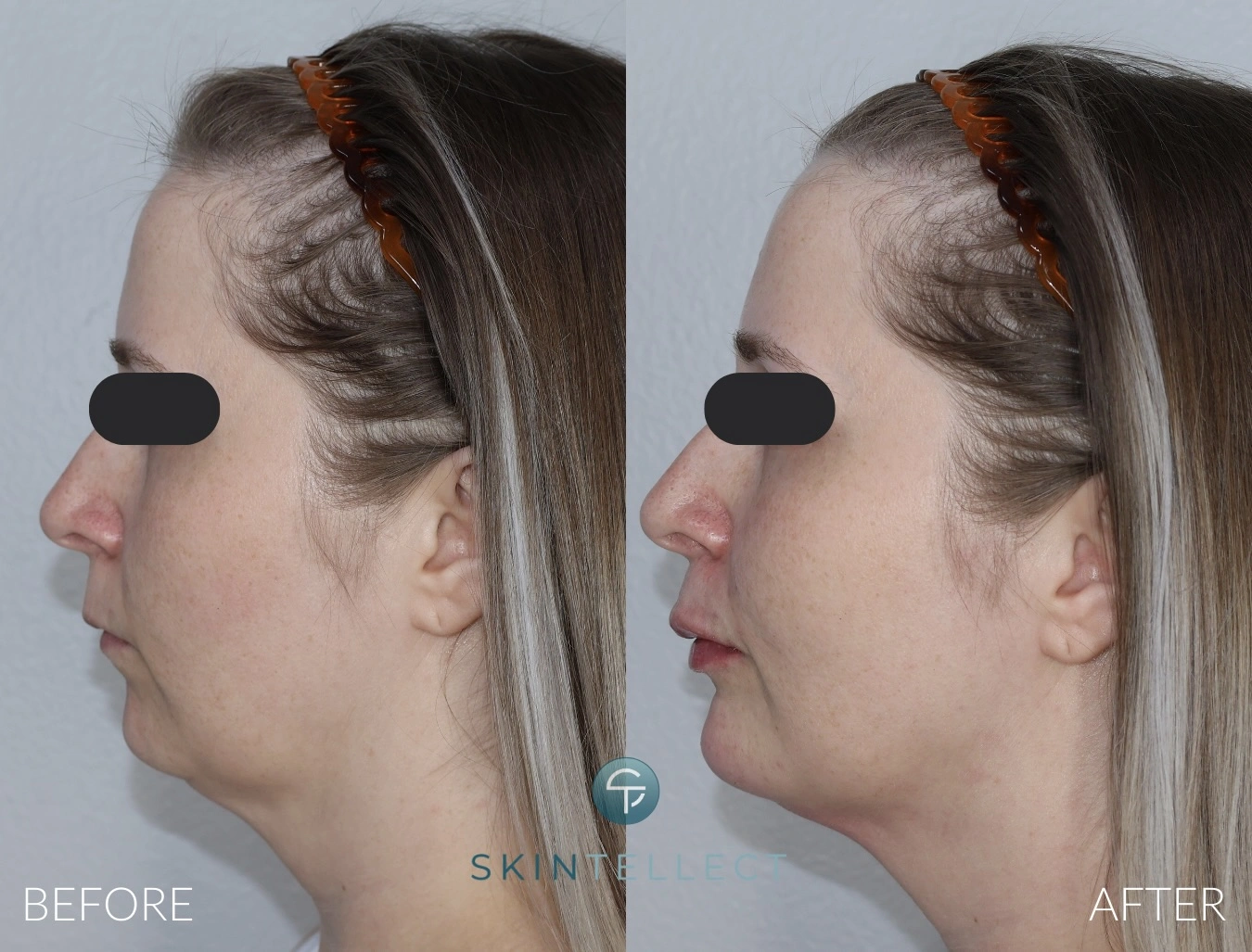 Chin Filler and Botox