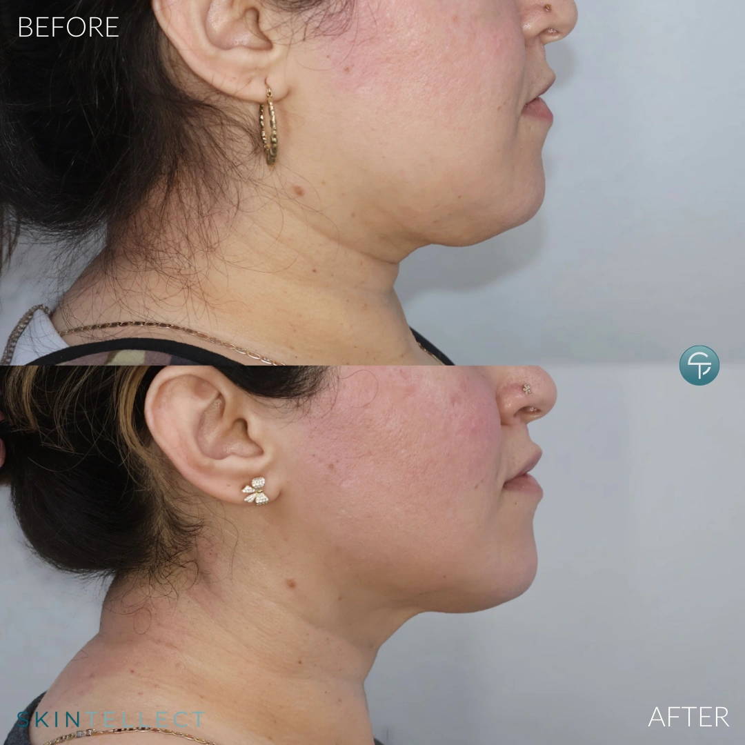 Nefertiti Lift with Botox for reducing double chin and neck lines