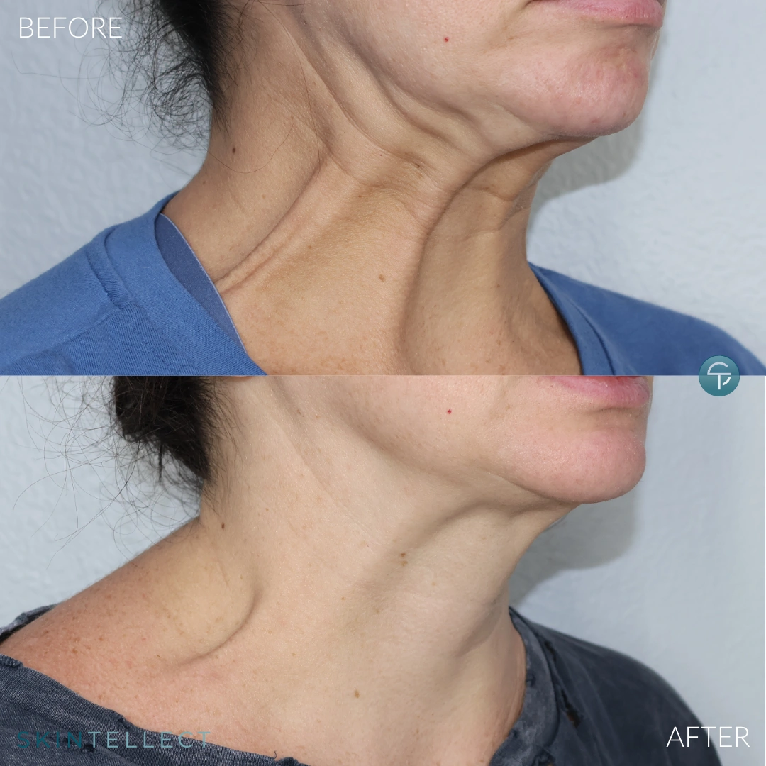 Nefertiti Lift with Botox
