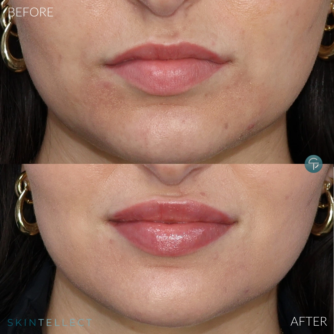 Before and after lip filler treatment for balancing uneven lips.