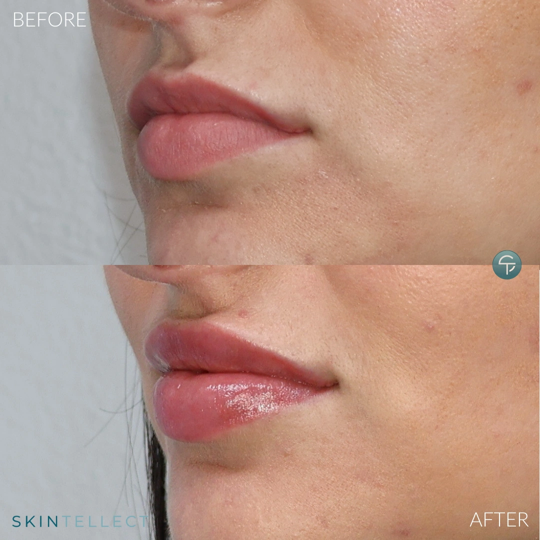 Before and after for plumping lips with lip filler