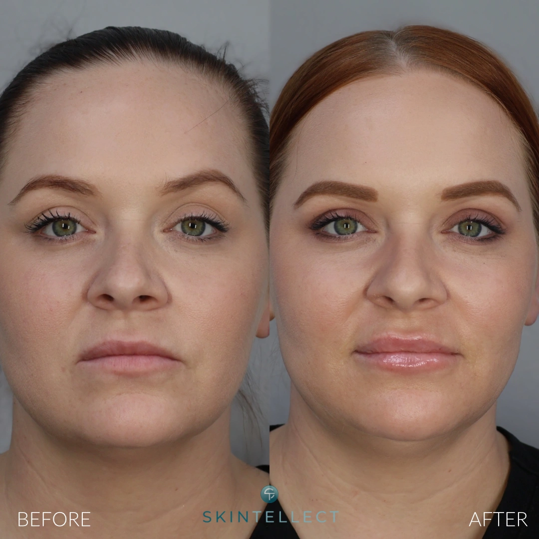 Before and after one syringe of lip filler