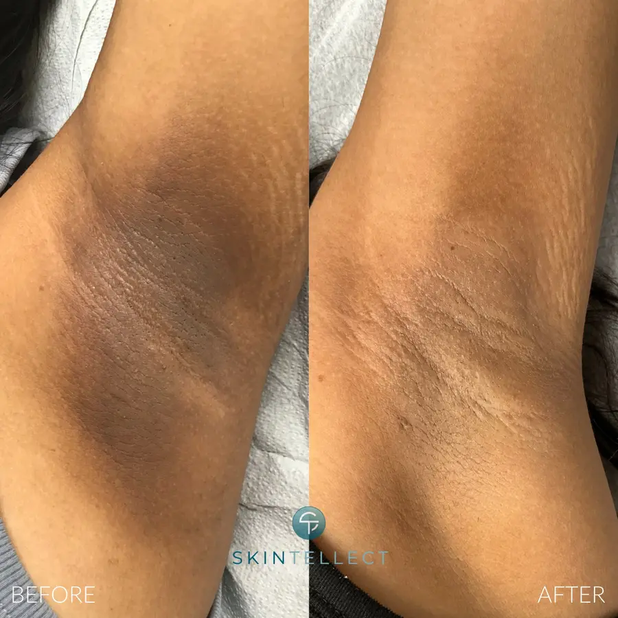 Laser Intimate Skin Lightening | 3 Sessions