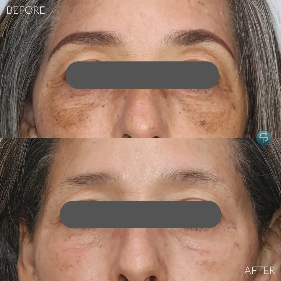 Laser Pigment Removal | 2 Sessions