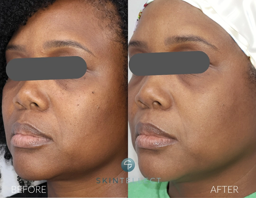 Laser Pigment Removal & DPN Removal | 2 Sessions