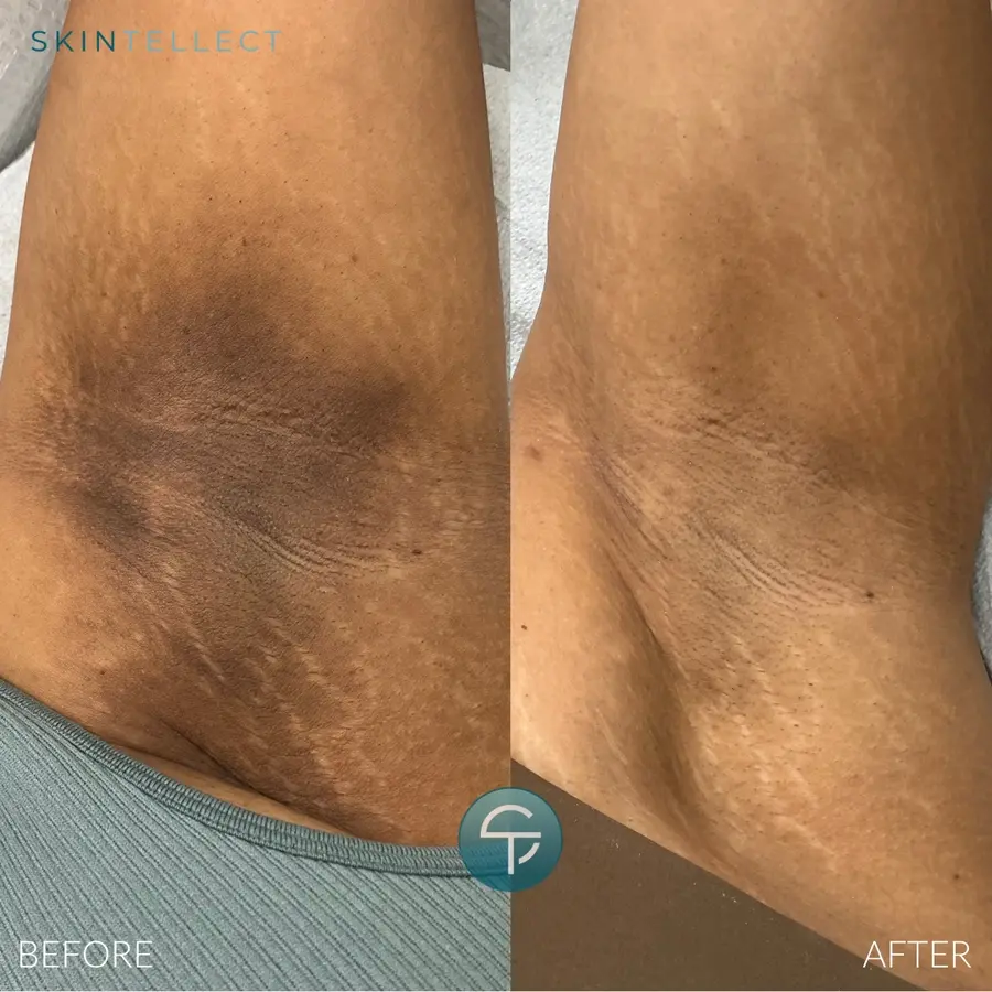 Laser Intimate Lightening | 4 Sessions
