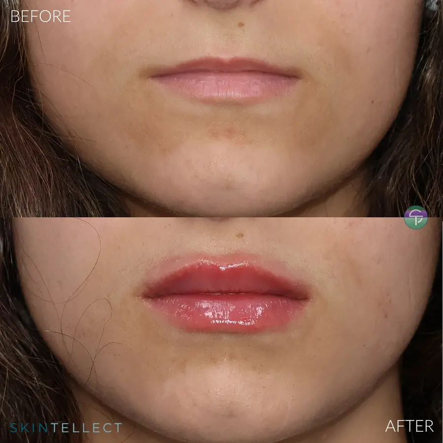 Lip Filler