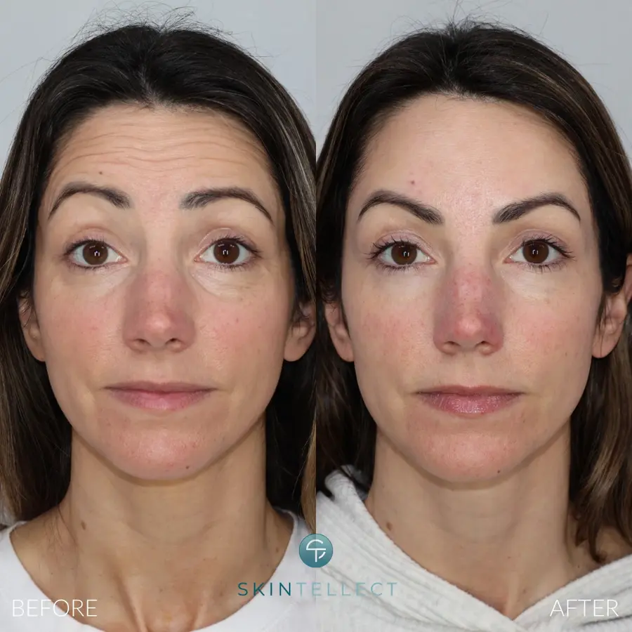 Forehead Botox