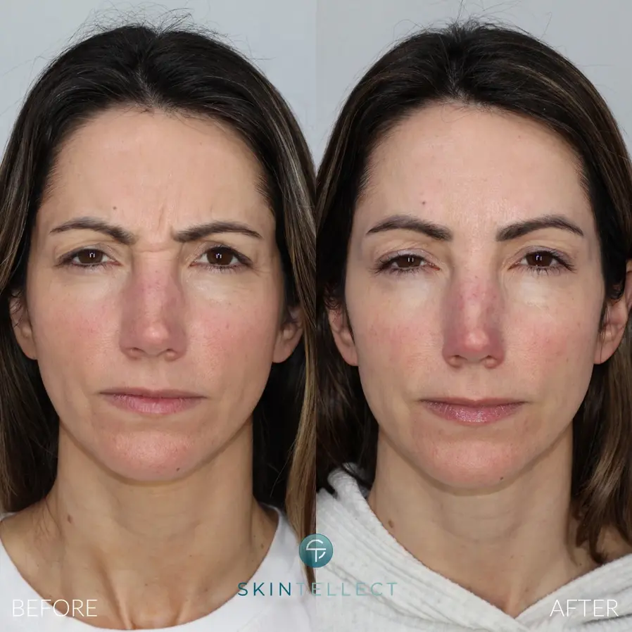 11's (Glabella) Botox