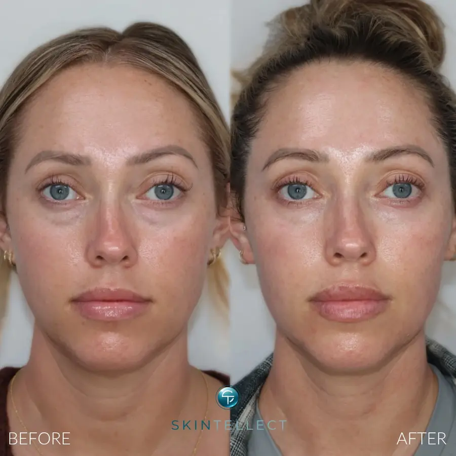 Under Eye Filler