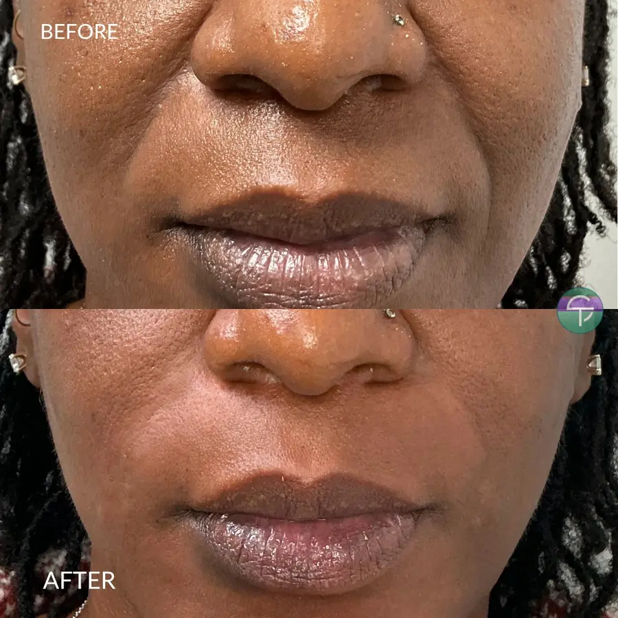 Smile Line Filler