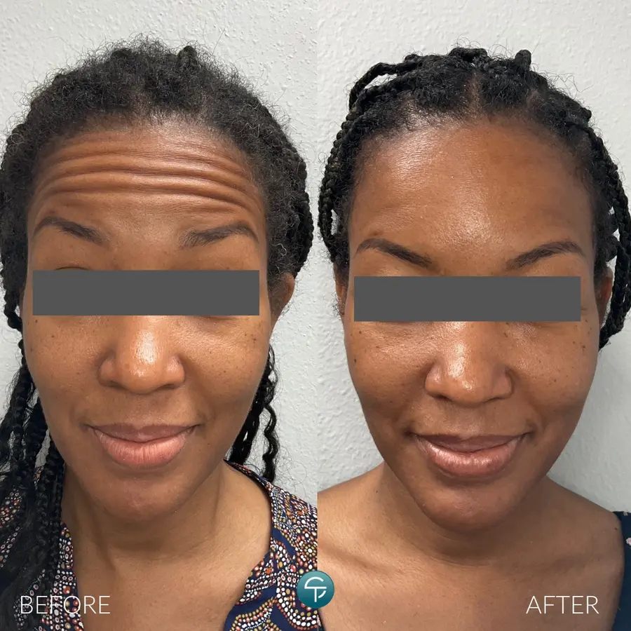 Forehead Botox