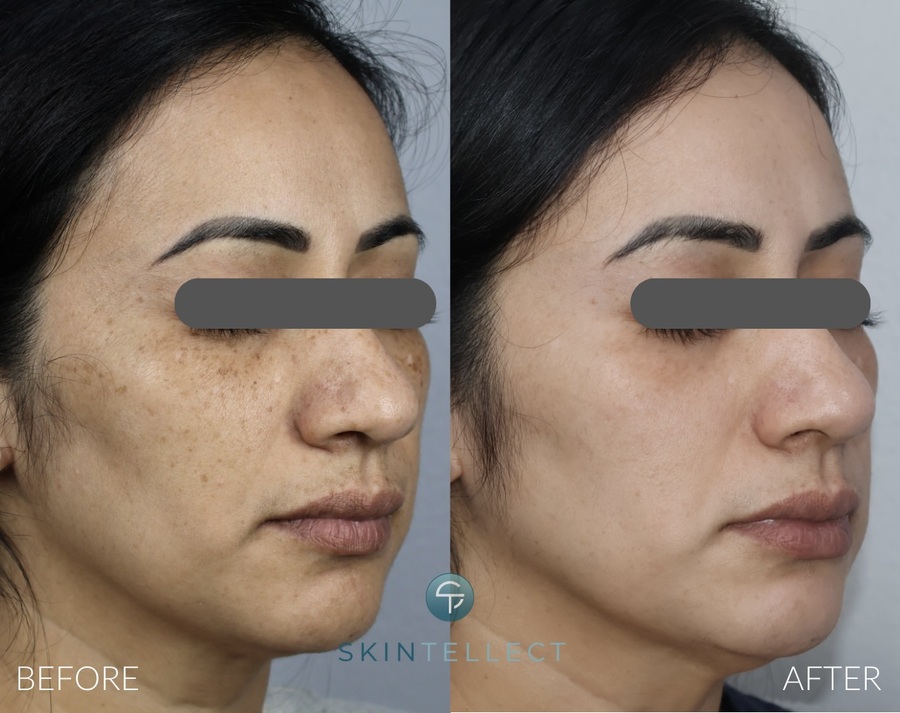 Laser Pigment Removal | 3 Sessions