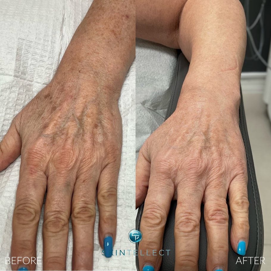 Laser Pigment Removal Hands | 5 Sessions