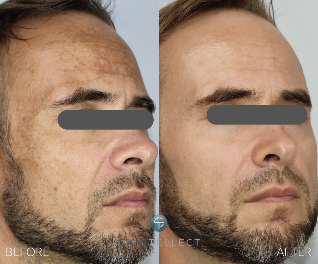 Laser Pigment Removal | 4 Sessions